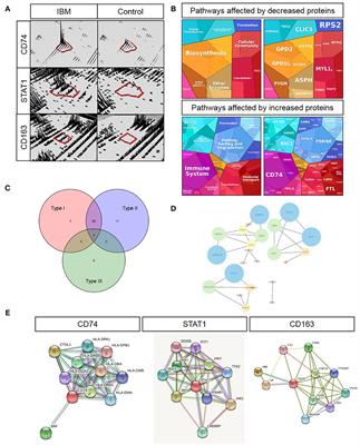 Proteomic Profiling Unravels a Key Role of Specific Macrophage Subtypes in Sporadic Inclusion Body Myositis